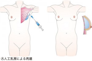 Ⓐ人工乳房による再建