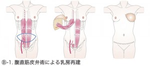 Ⓑ-1.腹直筋皮弁術による乳房再建