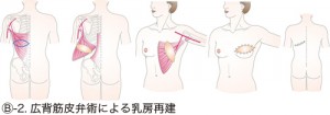 Ⓑ-2.広背筋皮弁術による乳房再建